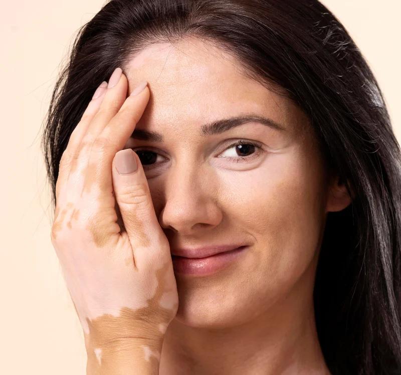 Ayurvedic Treatment for Vitiligo: Simple Ways to Support Skin Health